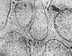 M,7y. | medulloblastoma M,7y. | medulloblastoma